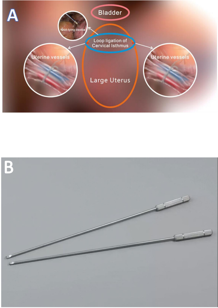 Loop ligation diagram of cervical isthmus and tools showing uterine vessels and knot-tying device.