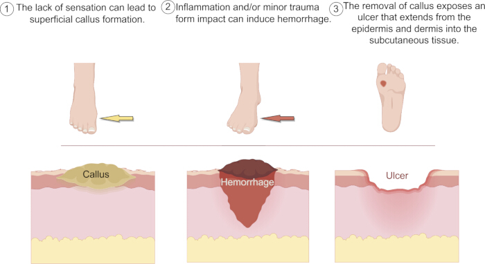 Diabetic foot ulcer development diagram; stages: callus, hemorrhage, ulcer from tissue damage.