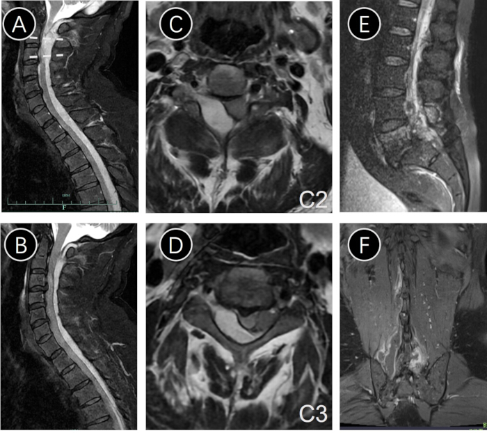 figure-introduction-1 MRI scans of cervical and thoracic spine, cross-section and sagittal views, radiological analysis.