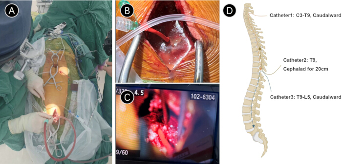 figure-results-1 Spinal surgery procedure and catheter placement; medical diagram and photos of surgical steps.