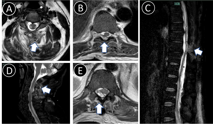 figure-results-2 Spinal MRI scans showing disc herniation at different vertebral levels, labeled A to E.