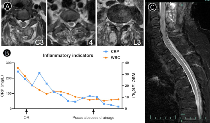 figure-results-3 Inflammatory indicators graph; MRI images of spine sections C3, T4, L3; post-drainage analysis.