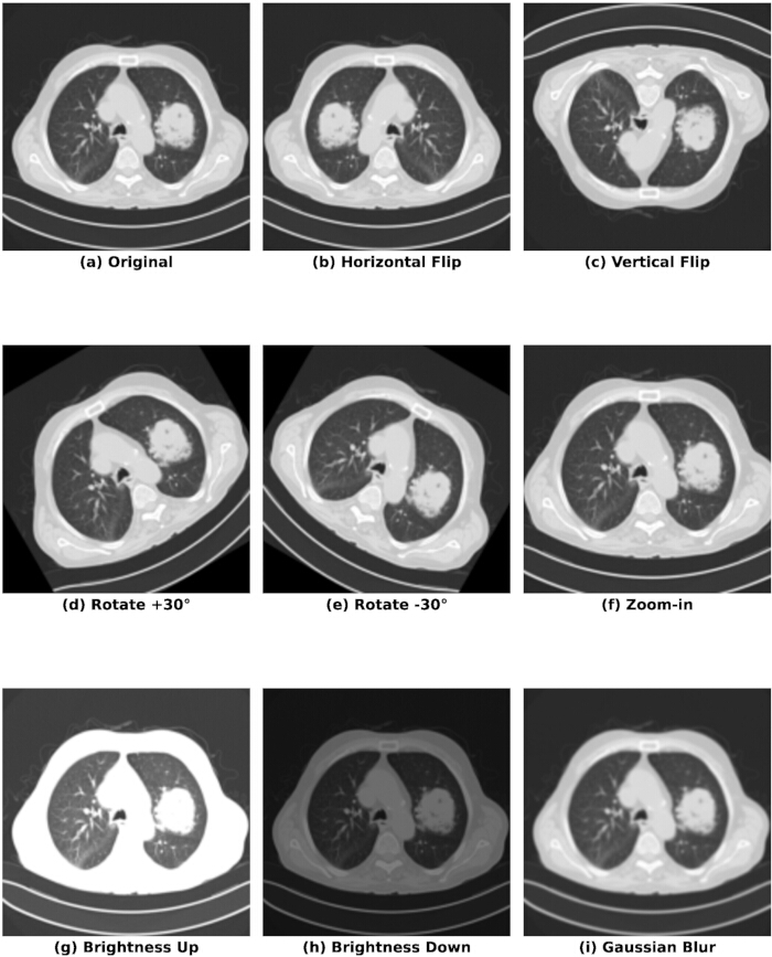 CT scan image processing: transformations and adjustments, includes rotation, flipping, and brightness.