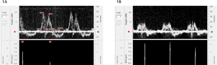 Doppler ultrasound waveform analysis, comparing cardiac cycle phases in diagnostic echocardiography chart.