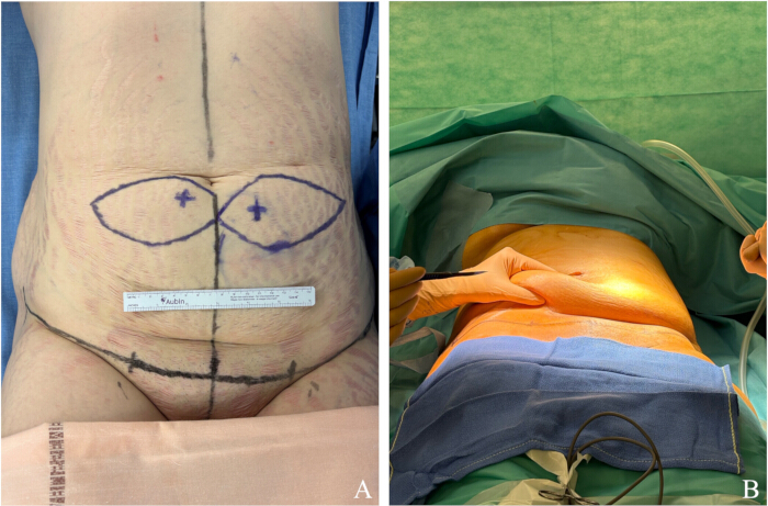 figure-protocol-1 Plastic surgery procedure planning and execution, preoperative diagram and surgical setup.