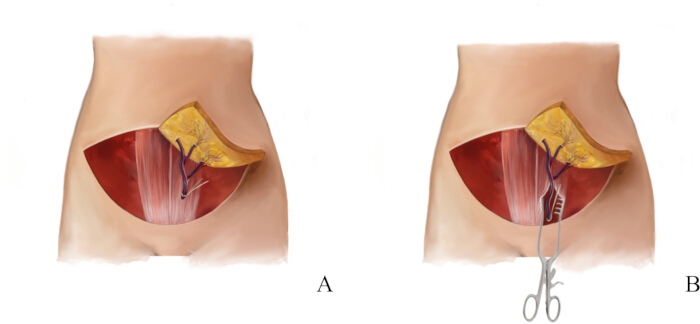Abdominal surgical procedure diagram showing muscle and tissue dissection, labeling steps A and B.