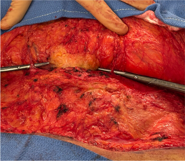 figure-protocol-2 Surgical procedure demonstrating tissue dissection using retractors, medical operation context.