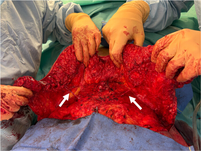 figure-protocol-3 Surgical procedure, fascia layer exposure, abdominal surgery, medical operation, clinical technique.