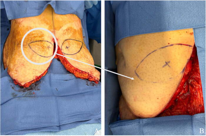 figure-protocol-4 Surgical incision planning; pre-op markings on tissue, medical procedure comparison, diagram.