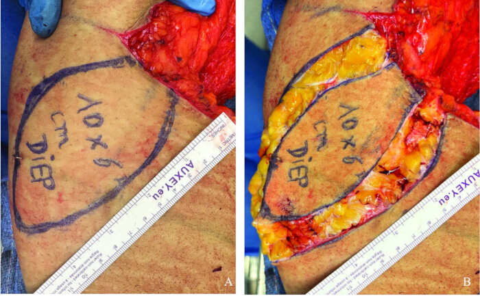figure-protocol-5 Surgical planning and incision marking for DIEP flap procedure, ruler scale indicates dimensions.