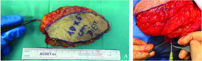 figure-protocol-6 Surgical graft process; A, tissue measurement; B, graft preparation; medical procedure diagram.