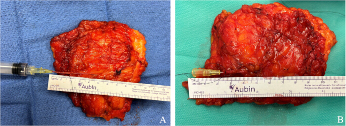 figure-protocol-7 Surgical tissue samples with measurement scales and syringe for size assessment in medical procedure analysis.
