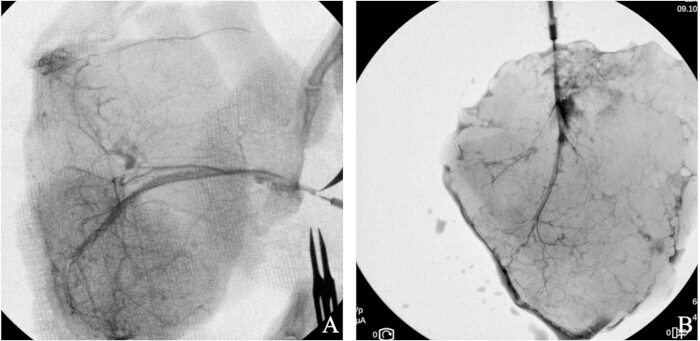 figure-protocol-8 Coronary angiogram, heart vessel visualization, diagnostic imaging, medical research.