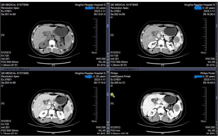 CT scan for abdominal analysis; medical imaging, diagnostic results, cross-sectional anatomy.