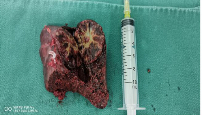 Pathological specimen comparison with syringe; medical examination result.