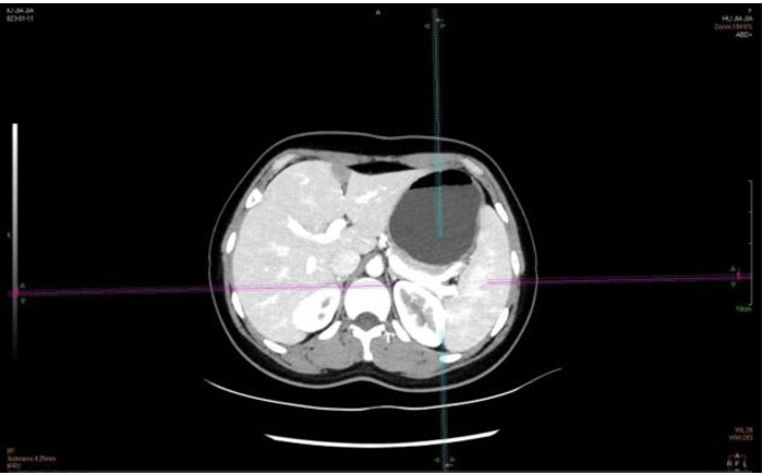 Abdominal CT scan; cross-sectional imaging for diagnostic analysis, tumor detection, pathology assessment.