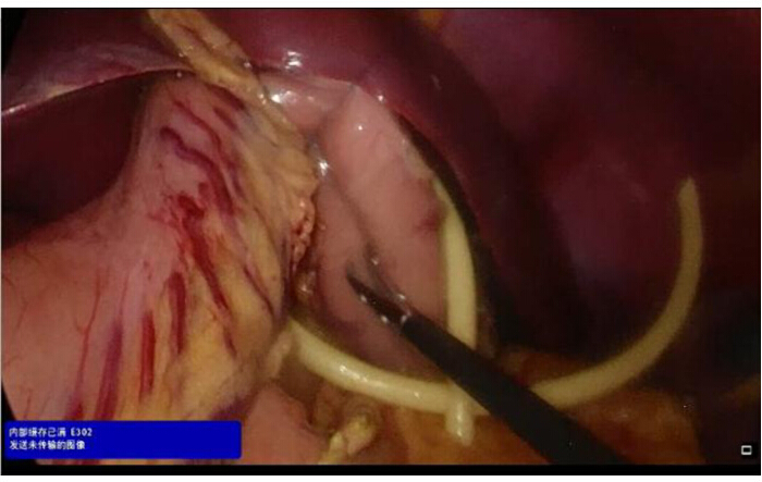 Surgical procedure, endoscopic view, highlighting tissue dissection and instrument details in medical context.