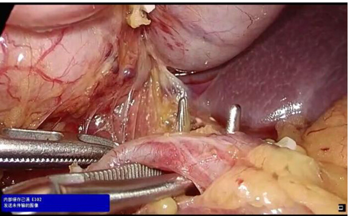 Surgical procedure, laparoscopic tools, anatomy visualization, medical operation close-up.