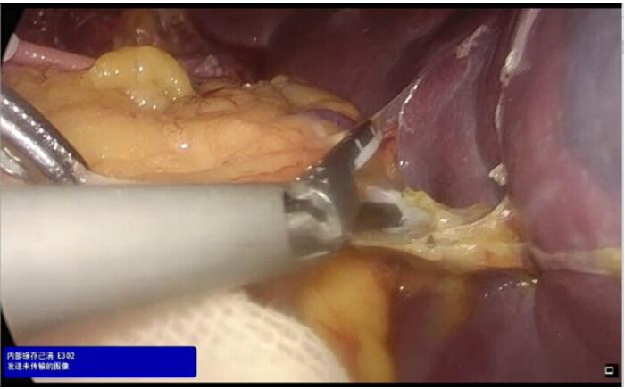 Laparoscopic surgery; tool incision, abdominal exploration, medical procedure demonstration.