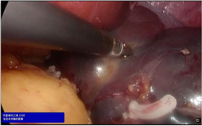 Laparoscopic procedure, surgical tool in liver dissection, endoscopic examination, medical operation.