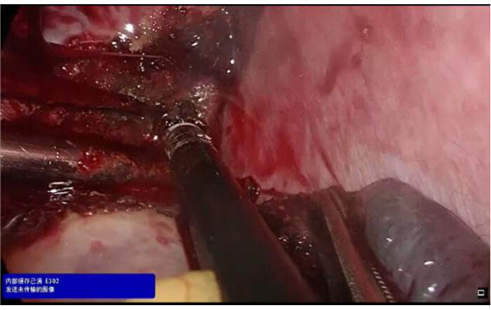 Surgical endoscopy procedure, internal view showing instruments, tissue dissection, medical operation.