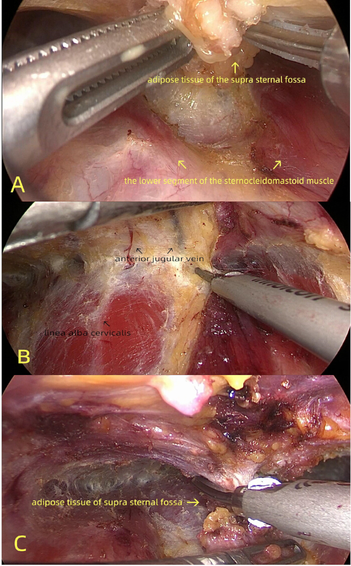 Surgical procedure steps on neck anatomy; highlighting sternocleidomastoid muscle, veins, adipose tissue.