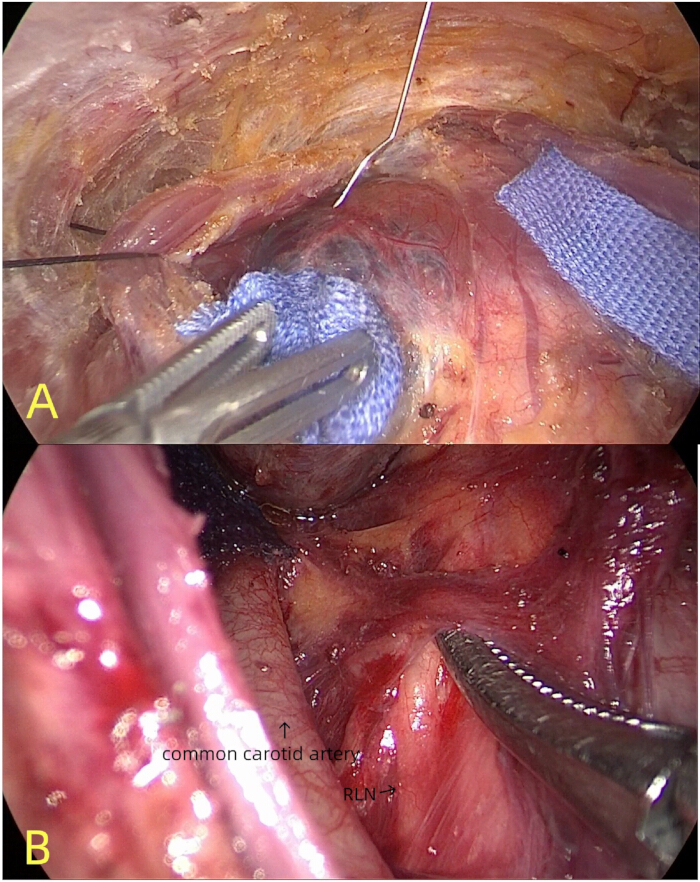 Surgical procedure showing carotid artery exposure and nerve identification in dissection images.