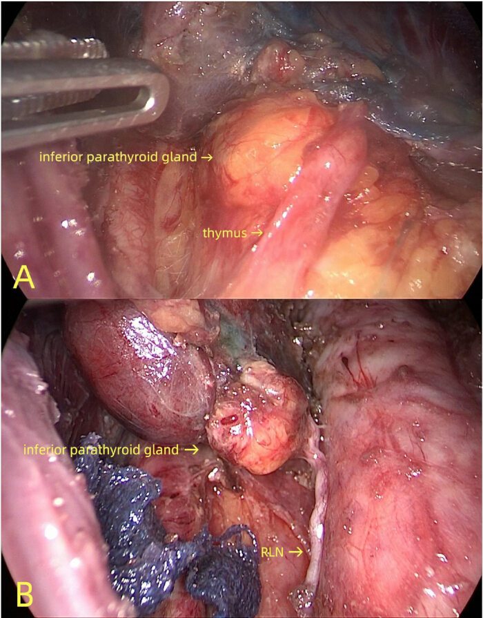 Inferior parathyroid gland, thymus, RLN identification; surgical anatomy, labeled medical images.