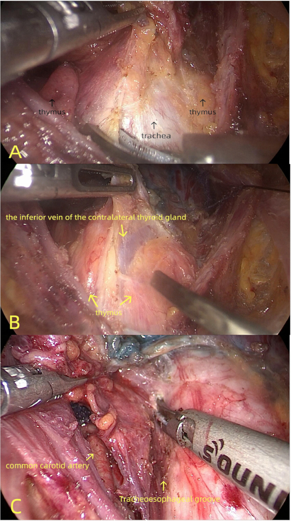 Surgical anatomy dissection; diagrams; trachea, thymus, thyroid gland vein, carotid artery visualization.