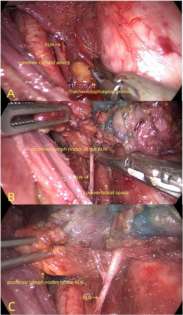 Endoscopic neck dissection images highlighting RLN, carotid artery, and lymph node anatomy.