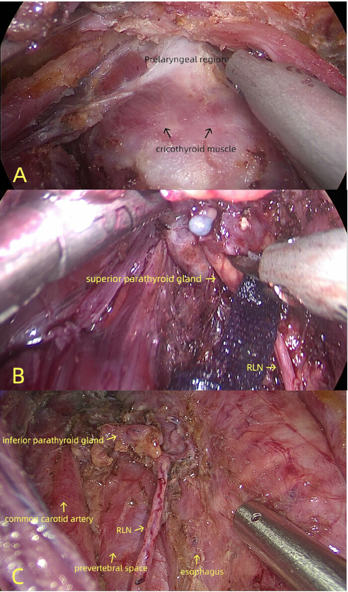 Surgical anatomy of neck: prelaryngeal, parathyroid, RLN; procedure illustrates key structures.