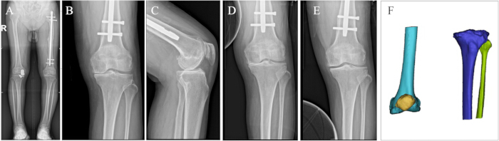 Knee replacement X-rays and 3D bone model; pre and post-surgery, alignment, fixation, prosthesis.