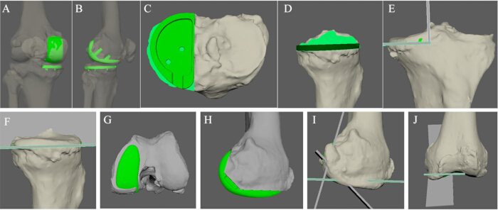 Knee joint 3D model analysis; diagrams A-J showing alignment and implant positioning strategies.