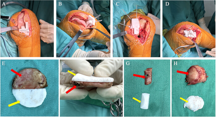 Knee surgery procedure series, cartilage repair, surgical instruments, tissue grafts, orthopedic method.