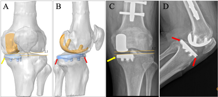 Knee joint replacement diagram and X-ray; prosthetic alignment analysis; orthopedic study.