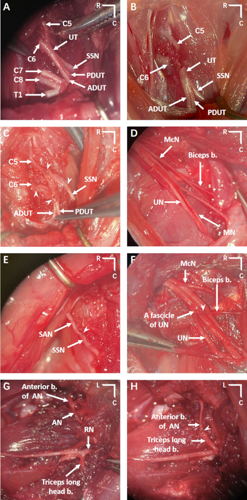 Anatomical dissection, nerve pathways diagram, upper limb, human anatomy, surgical study.