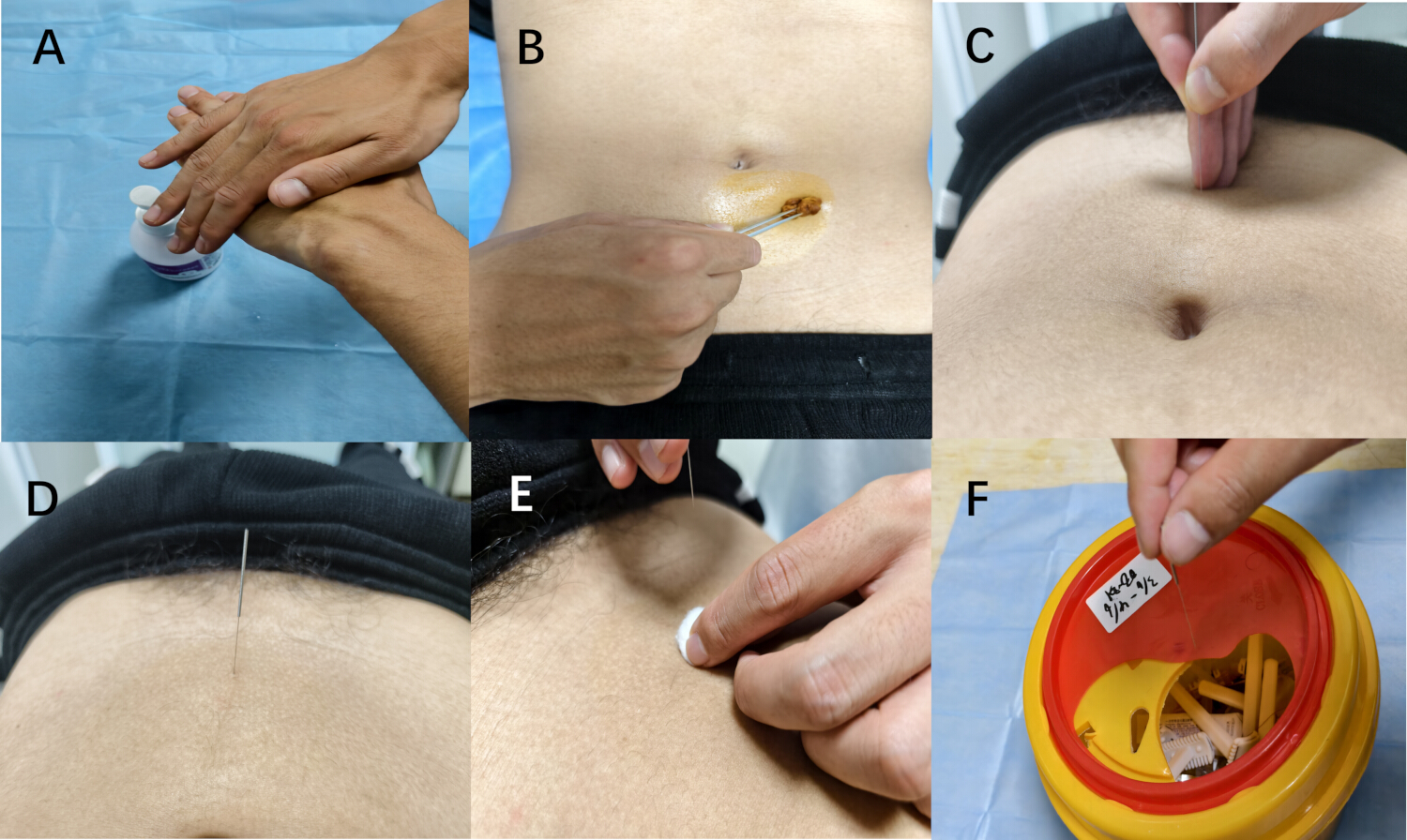 A Traditional Chinese Medicine Characteristic Therapy for Erectile ...