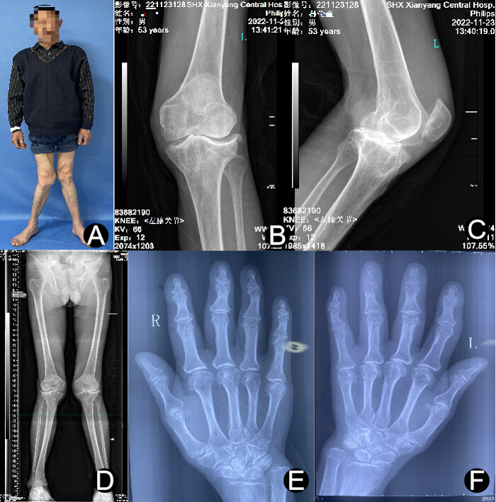 Skeletal deformity analysis with X-ray images of knees, legs, and hands, medical diagnosis.