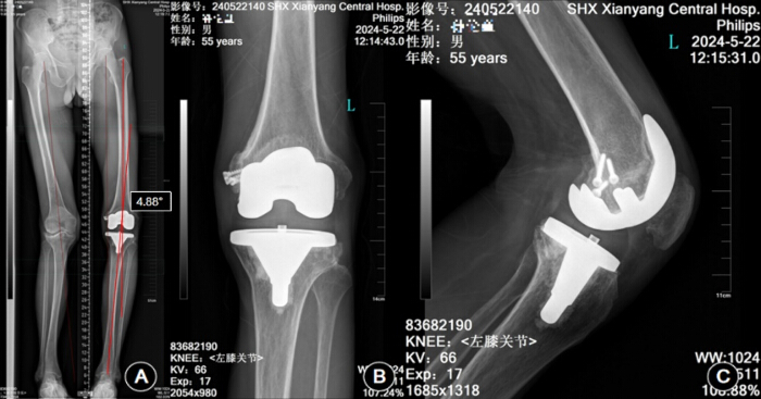 Knee replacement X-ray; frontal and lateral view; post-operative alignment; 4.88-degree angle.