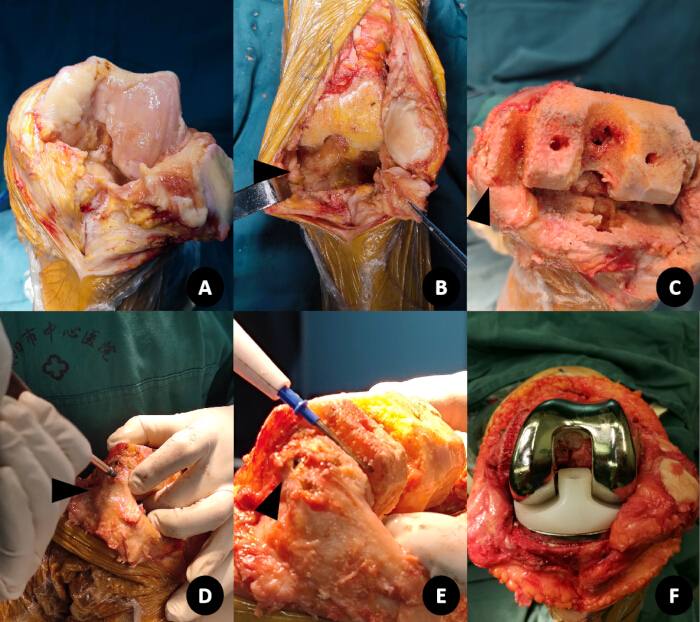 Surgical knee replacement steps; medical procedure; anatomy dissection; prosthesis implant fitting.