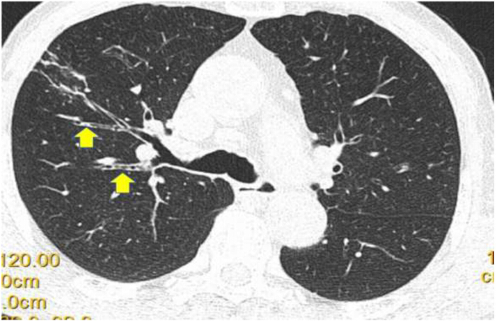 figure-results-1 CT scan showing lung nodules; radiology analysis; early disease detection; medical imaging study.