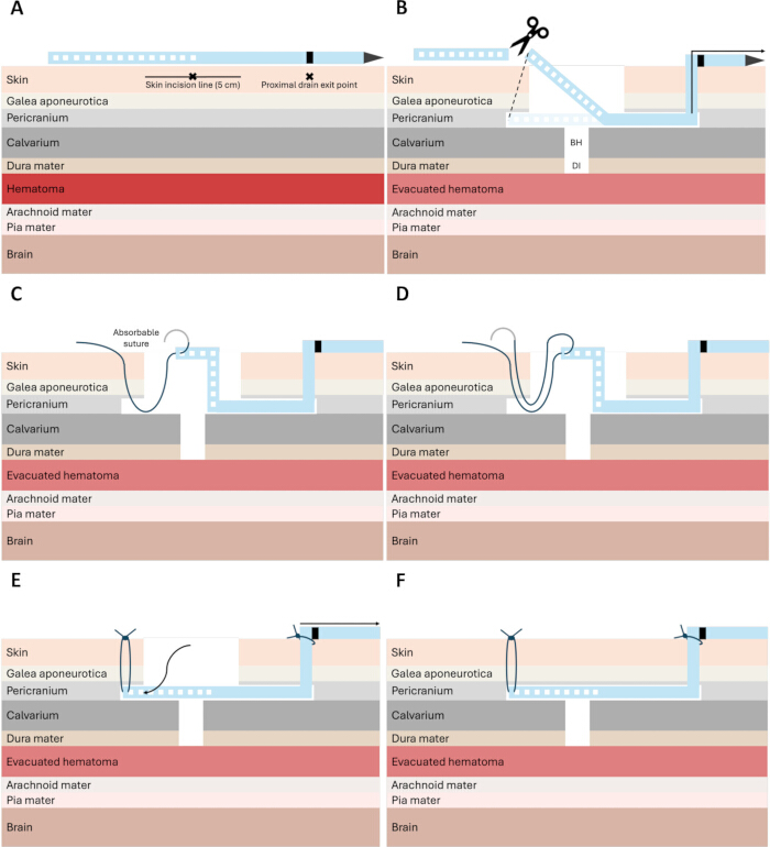 figure-results-1 Chronic subdural hematoma drainage procedure diagrams; surgical steps with anatomical labels.