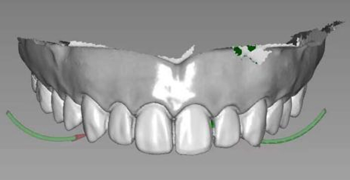 3D dental model showing upper teeth alignment, CAD software, orthodontic analysis, morphology.