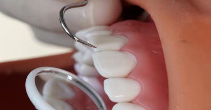 Dental examination demonstrating oral care with mirror and probe; dental hygiene procedure.