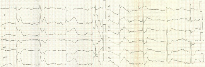 Electrocardiogram (ECG) graph showing heart electrical activity, lead tracings, clinical diagnosis.