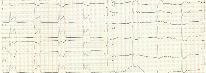 Electrocardiogram diagram showing heart's electrical activity across various leads for cardiac analysis.