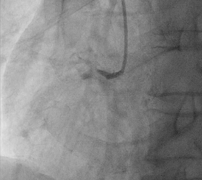 Cardiac angiography image showing coronary artery flow analysis.