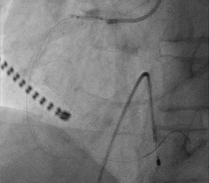 Cardiac catheterization X-ray, coronary angiography, arterial catheter imaging, diagnostic procedure.