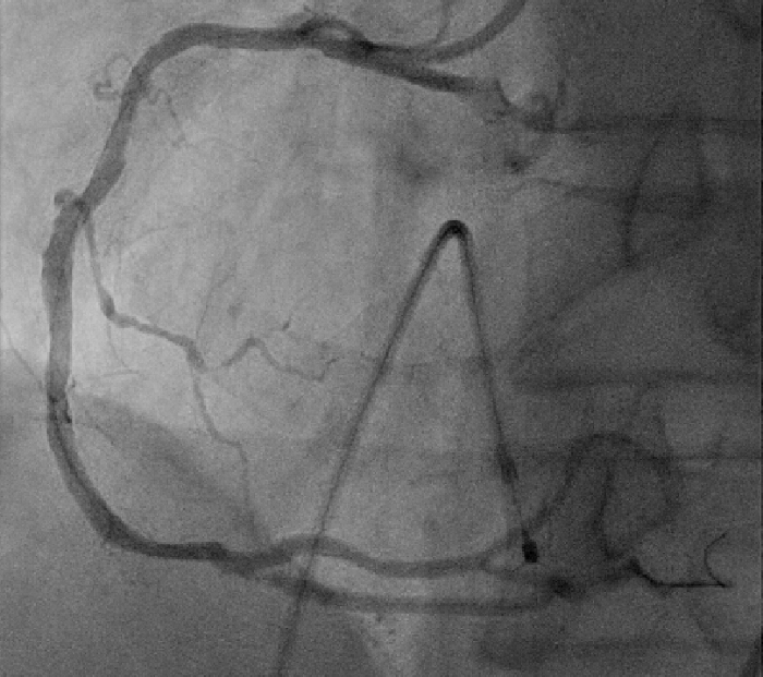 Coronary angiography, catheter inserted in artery, cardiovascular imaging, medical diagnostic diagram.