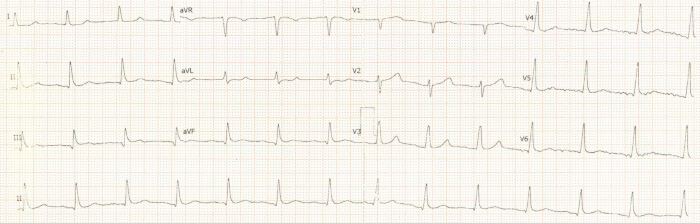 Electrocardiogram diagnostic chart showing heart electrical activity; medical analysis tracing.